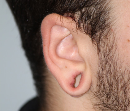 ear-surgery-before-The-Woodlands-Houston
