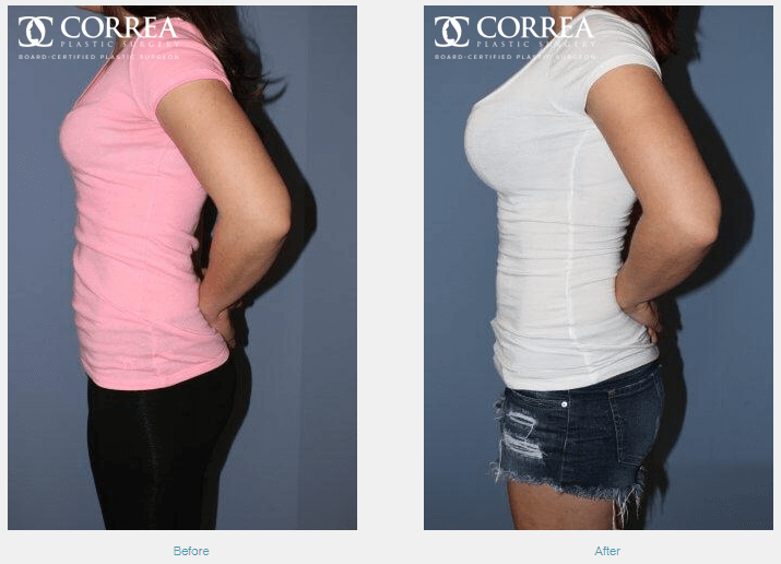 What Is the Best Age For Breast Augmentation?