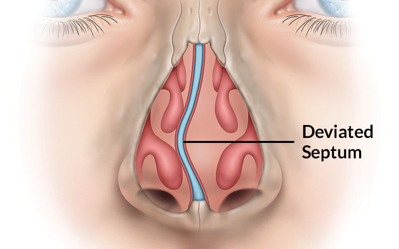 Deviated-Septum-pic