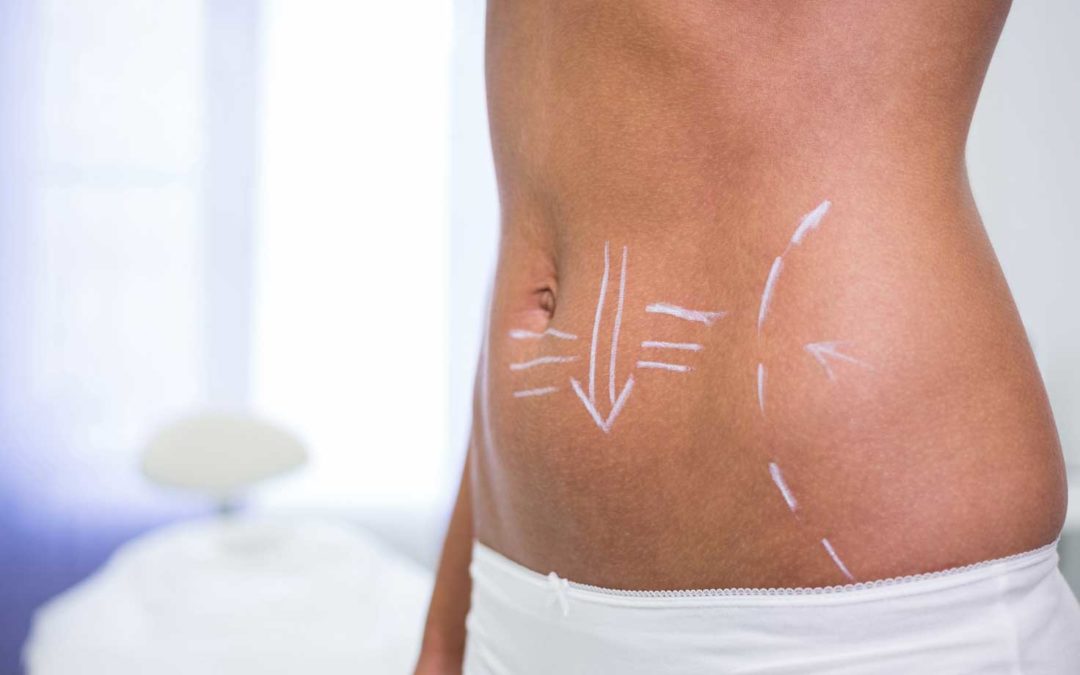 Does Liposuction Require A Lot of Downtime?