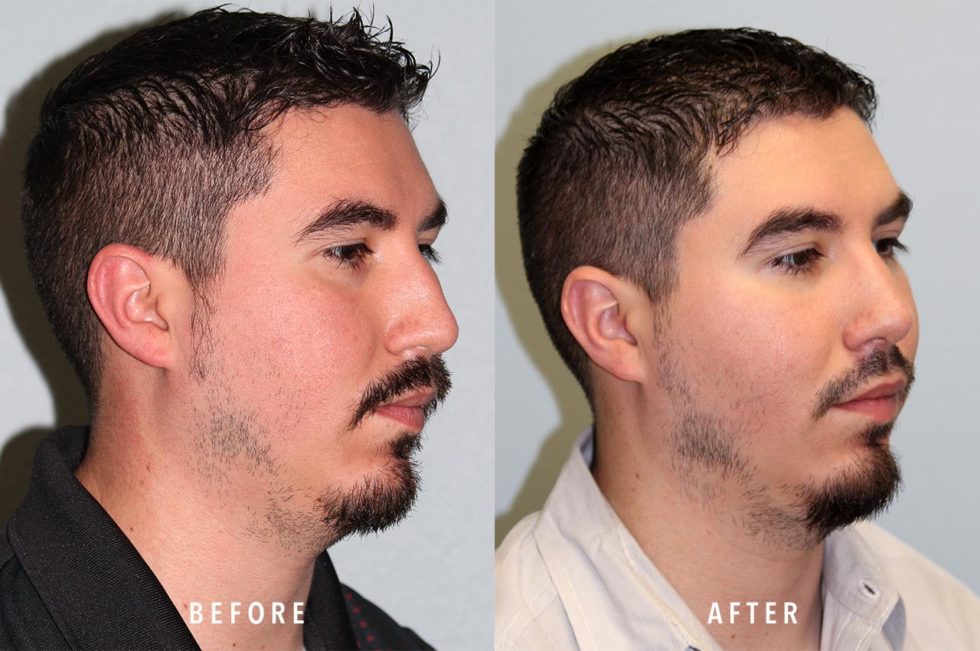 Rhinoplasty - 2030 - The Woodlands Plastic Surgery