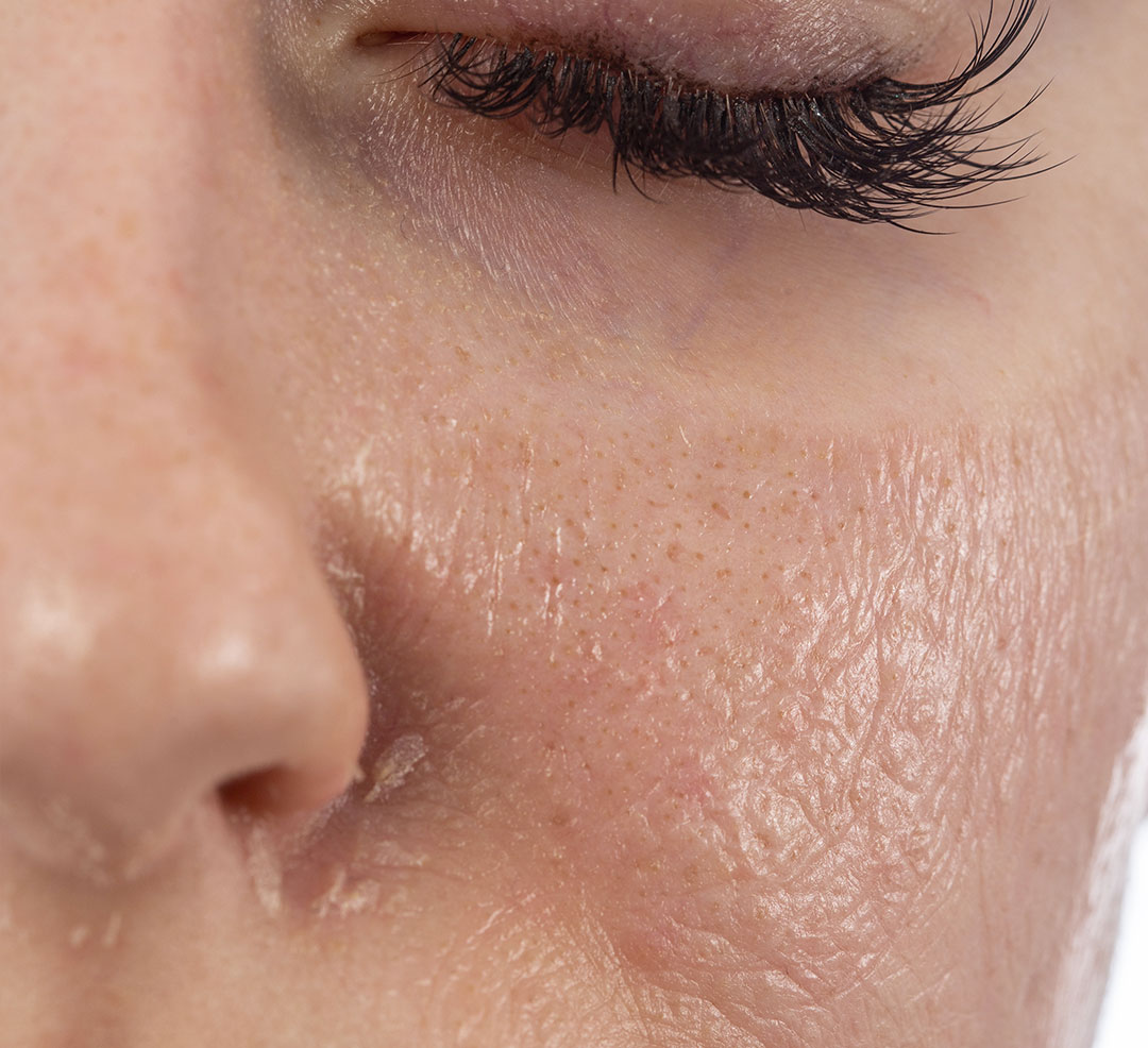 chemical-peel